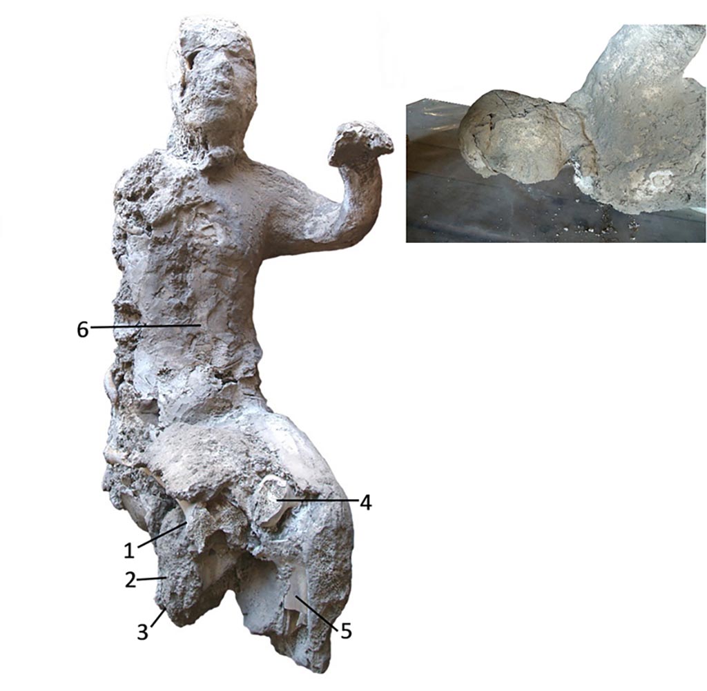 Victim 34 with pXRF measuring points (1–6) used in The Casts of Pompeii Project.
Cast #34 (Fig 8) from Terme Suburbane is a male adult individual (20–25 years old). The original position of the individual was right lateral decubitus. The right arm had the elbow flexed, separated from the body. The legs were parallel following the longitudinal axis of the body.
No obvious pathological conditions in victim 34 from Terme Suburbane, were observed.
Photo courtesy of The Casts of Pompeii Project. Use subject to CC BY 4.0 Deed 
See Alapont L, Gallello G, Martinón-Torres M, Osanna M, Amoretti V, Chenery S, et al. (2023) The casts of Pompeii: Post-depositional methodological insights. PLoS ONE 18(8): e0289378, p. 9/19, fig. 8. https://doi.org/10.1371/journal.pone.0289378 
Victim 34 may be a female, aged 13-19 years?
The victim was found in the Suburban Baths on the 28th of April 1960, roughly in the area between rooms 14-4-12-13.
There were traces of drapery on the waist and hips.
See Osanna, N., Capurso, A., e Masseroli, S. M., 2021. I Calchi di Pompei da Giuseppe Fiorelli ad oggi: Studi e Ricerche del PAP 46, p. 400-401, Calco n. 34.
