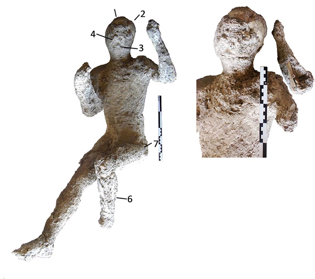 Victim 58. Cast #58 and pXRF measuring points (1–6).
Photo courtesy of The Casts of Pompeii Project. Use subject to CC BY 4.0 Deed 
The cast #58 (Fig 4) is an adult individual (20–25 years old) identified as a male. This was divided into 7 parts before its restoration. This cast appears to preserve the morphology of the right ear.
Individual #58 also presents hypoplasia in the left lateral incisor and dental wear on the lower left lateral incisor, and also an enthesophyte of the left patella.
The radiological examination also revealed traumatic perimortem fractures in the tibia and fibula of the right leg of the cast #58. These fractures appear to have occurred close to the time of death of the individuals.
See Alapont L, Gallello G, Martinón-Torres M, Osanna M, Amoretti V, Chenery S, et al. (2023) The casts of Pompeii: Post-depositional methodological insights. PLoS ONE 18(8): e0289378, Fig 4. https://doi.org/10.1371/journal.pone.0289378 

Victim 58 is an adult male aged over 20 years.
The body was found outside Porta Nola, near the tomb of M. Obellius Firmus, between the 2nd of August and the 21st of September 1976.
It seems we can distinguish some traces of clothing on the victim's torso and legs.
See Osanna, N., Capurso, A., e Masseroli, S. M., 2021. I Calchi di Pompei da Giuseppe Fiorelli ad oggi: Studi e Ricerche del PAP 46, p. 457-8, Calco n. 58.

