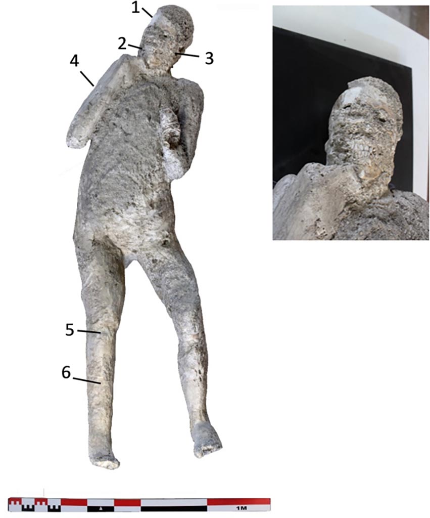 Victim 62. Cast #62 and pXRF measuring points (1–6).
The cast #62 is an adult individual (25–30 years old) identified as female, found interlaced to the left hand-forearm and holding a rope that would go over the left shoulder carrying a sack or bag. The original position of this individual was prone with the head resting on the face.
Photo courtesy of The Casts of Pompeii Project. Use subject to CC BY 4.0 Deed 
See Alapont L, Gallello G, Martinón-Torres M, Osanna M, Amoretti V, Chenery S, et al. (2023) The casts of Pompeii: Post-depositional methodological insights. PLoS ONE 18(8): e0289378, fig. 3. https://doi.org/10.1371/journal.pone.0289378 

Victim 62 is an adult male over 20 years of age.
The cast was found outside Porta Nola near the tomb of M. Obellius Firmus between the 2nd of August and the 21st of September 1976.
On the left forearm the drapery of the sleeve of the robe appears to be legible.
See Osanna, N., Capurso, A., e Masseroli, S. M., 2021. I Calchi di Pompei da Giuseppe Fiorelli ad oggi: Studi e Ricerche del PAP 46, p. 465-6, Calco n. 62.

